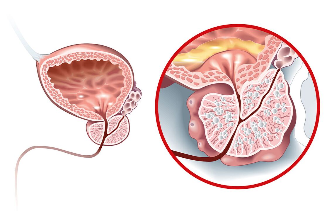 Kas atsitinka su prostata su adenoma ir prostatitu