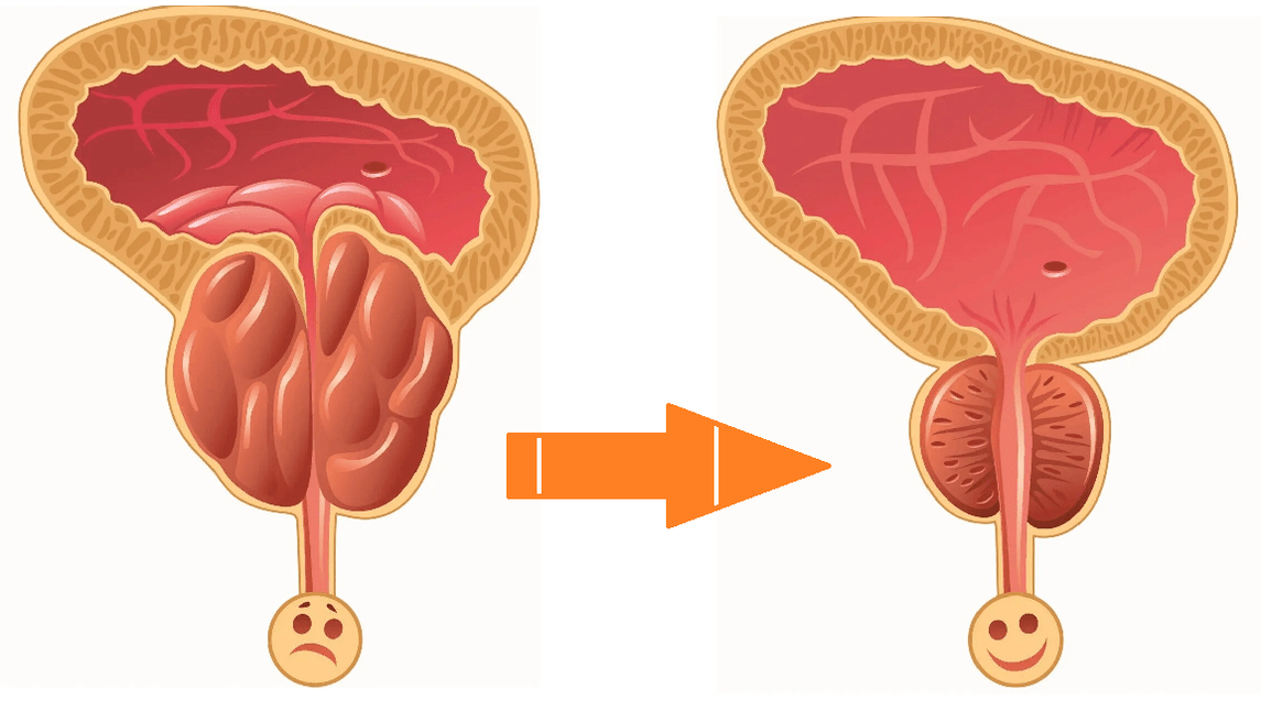 Uromexil Forte poveikis prostatai su prostatitu ir adenoma